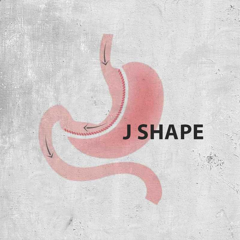 تكميم المعدة  J shape